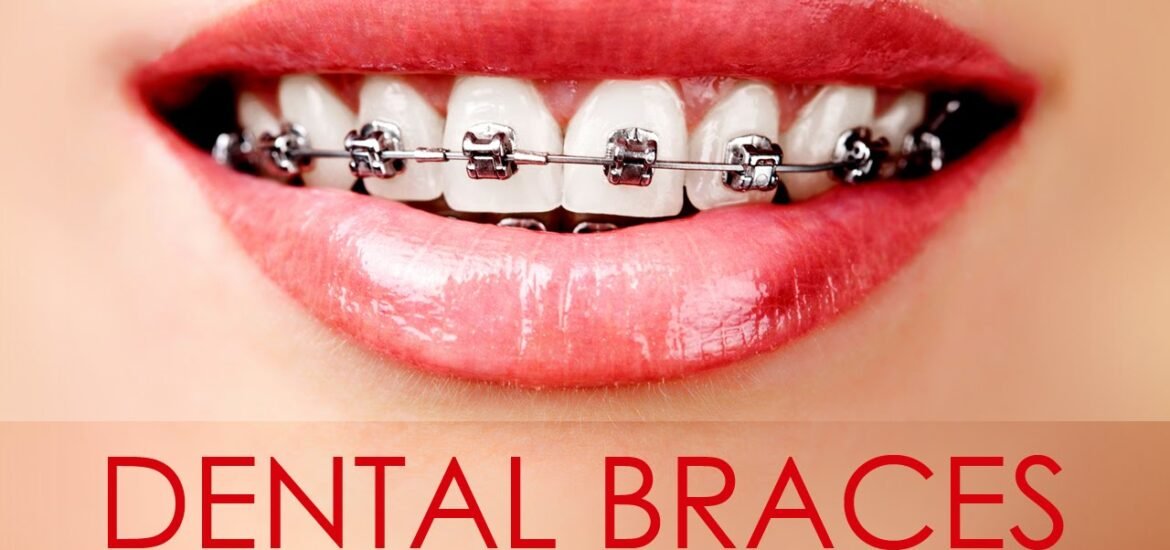 Things To Know Before You Get Dental Braces