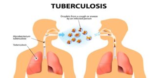 Home Treatments For Tuberculosis