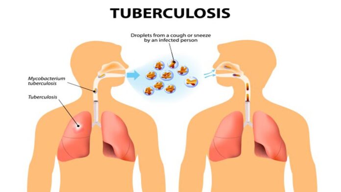 Home Treatments For Tuberculosis